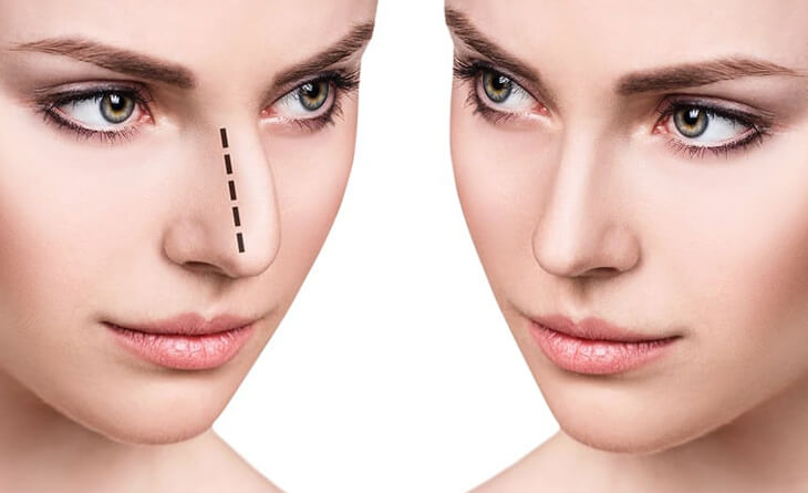 How Long Does a Nose Job Take to Heal - Rhinoplasty Surgery in Delhi - Dr Rajat Gupta Rhinoplasty Surgery in Delhi
