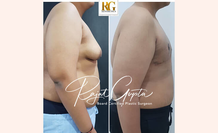 Is Gynecomastia Surgery Covered by Insurance in India - Dr Rajat Gupta - Plastic Surgeon in Delhi -01 Gynecomastia Surgery Before and After