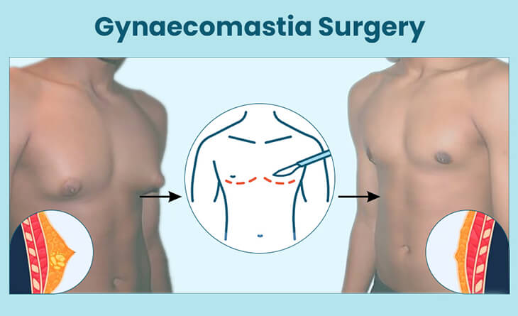 Is Gynecomastia Surgery Covered by Insurance in India - Dr Rajat Gupta - Plastic Surgeon in Delhi Gynecomastia Procedure in Delhi