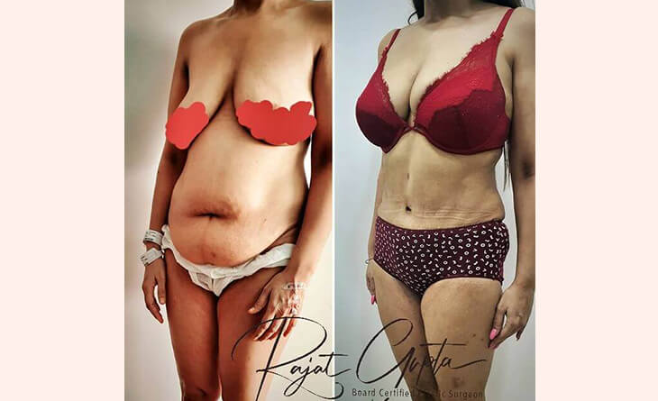 Liposuction Surgery Before and After - Liposuction Surgery Cost in Delhi - Dr Rajat Gupta Liposuction Surgery Before and After - Liposuction Surgery Cost in Delhi - Dr Rajat Gupta