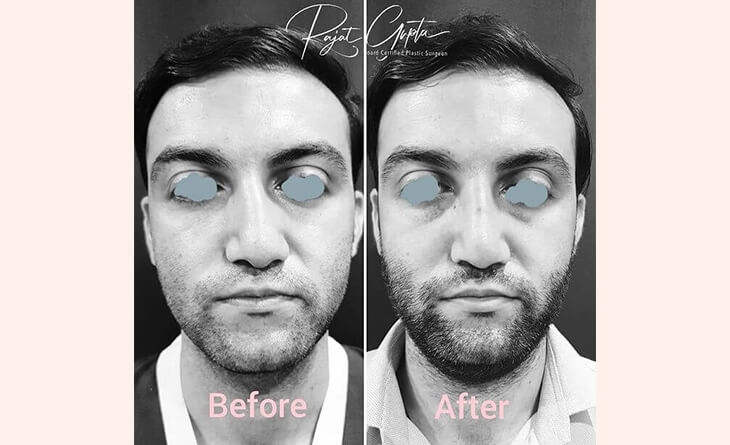 Rhinoplasty Surgery Before and After - Dr Rajat Gupta Rhinoplasty Surgery Before and After