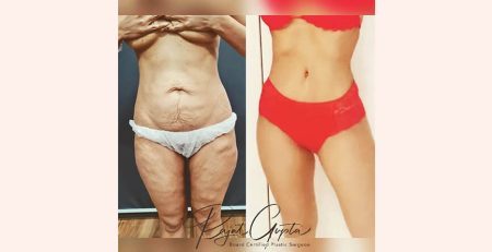 Tummy Tuck Surgery before and after