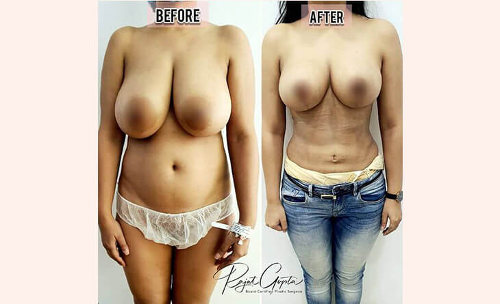 Breast Reduction Surgery Before and after result