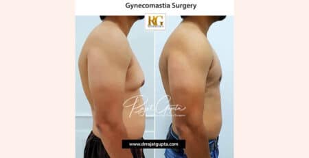 Is Gynecomastia a Big Surgery