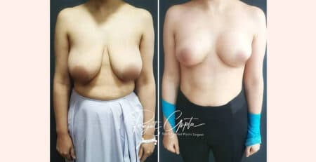 Breast Lift Surgery in Delhi
