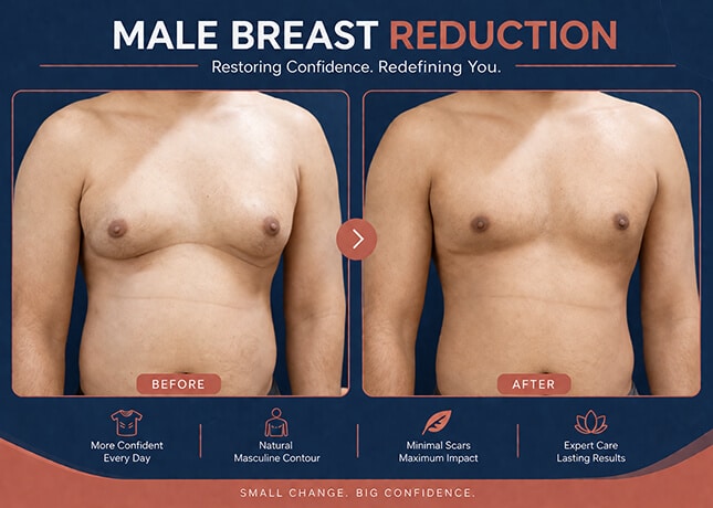 Gynecomastia Surgery Before After Result - Scarless Male Breast Reduction with Dr Rajat Gupta
