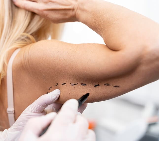 Arm lift surgery - Dr Rajat Gupta - Plastic Surgeon in India
