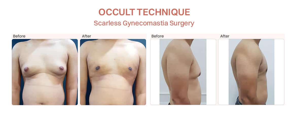 Gynecomastia Surgery Before and After Results- OCCULT technique- Dr Rajat Gupta - RG Aesthetics