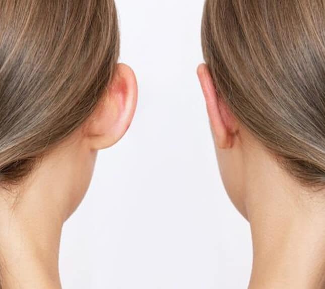 Otoplasty Surgery - Ear pinning surgery - Dr Rajat Gupta - Plastic Surgeon in Delhi