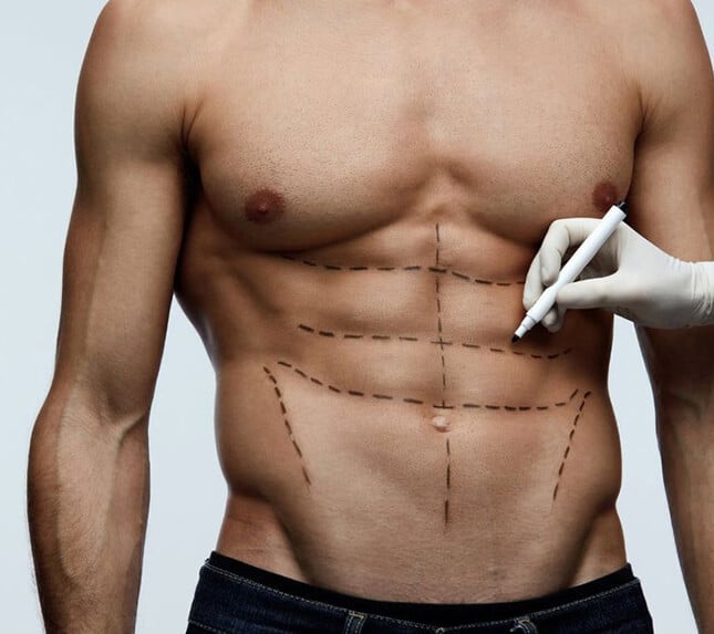 Six-Pack Abs Surgery - High-definition liposuction - Dr Rajat Gupta - Plastic Surgeon in India